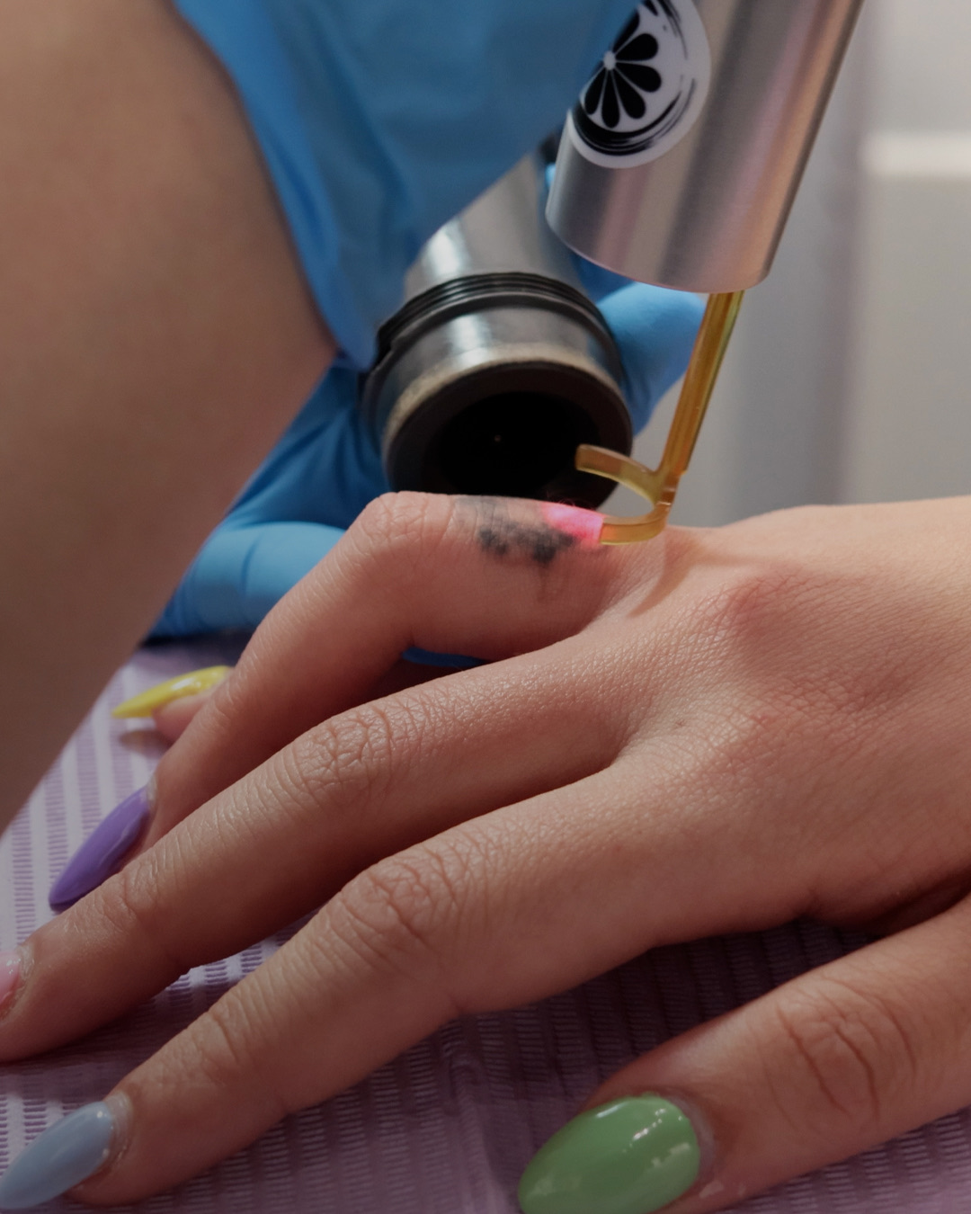 PicoWay laser tattoo removal in progress on a finger at Studio Kiku