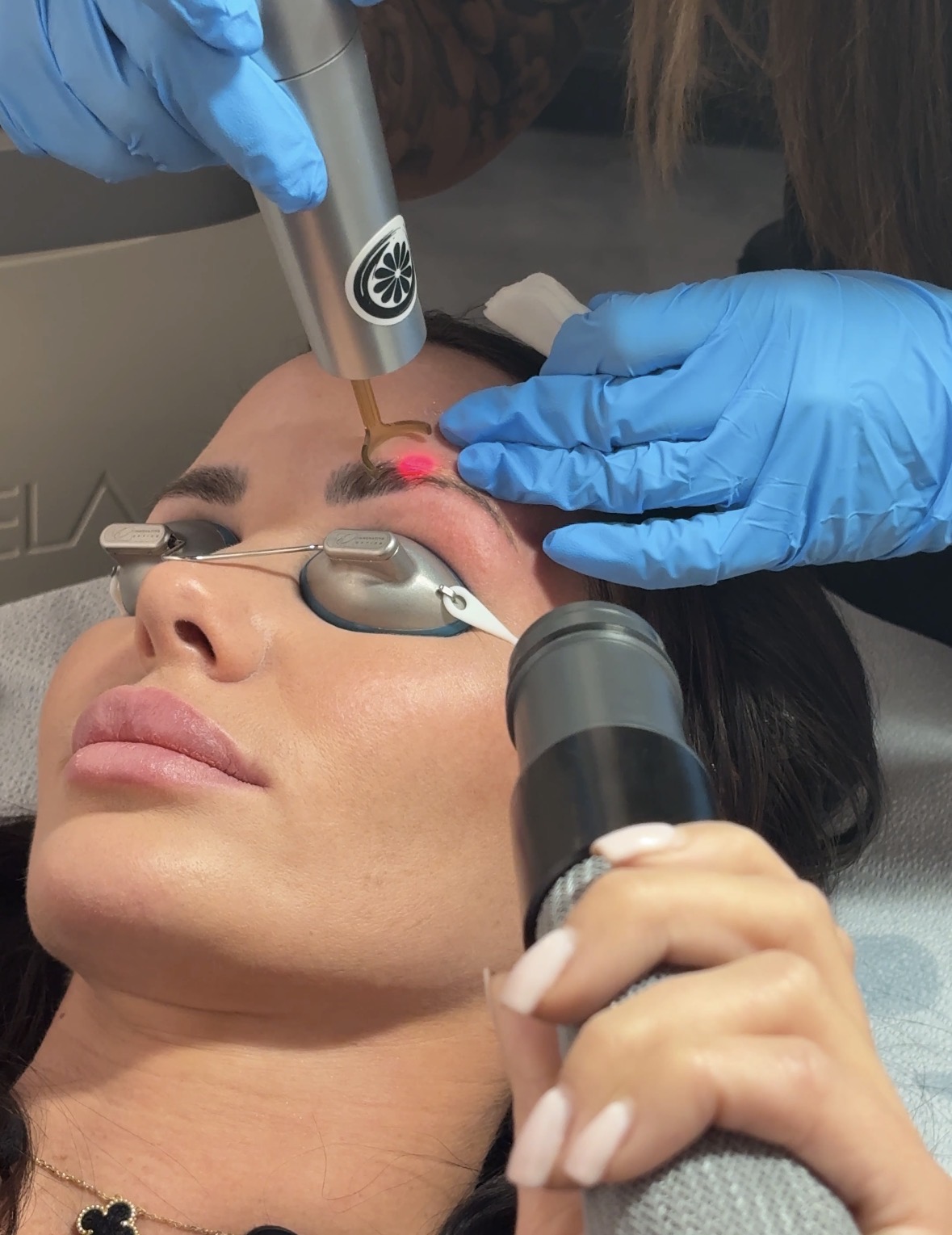 Laser removal of permanent makeup brows at Studio Kiku