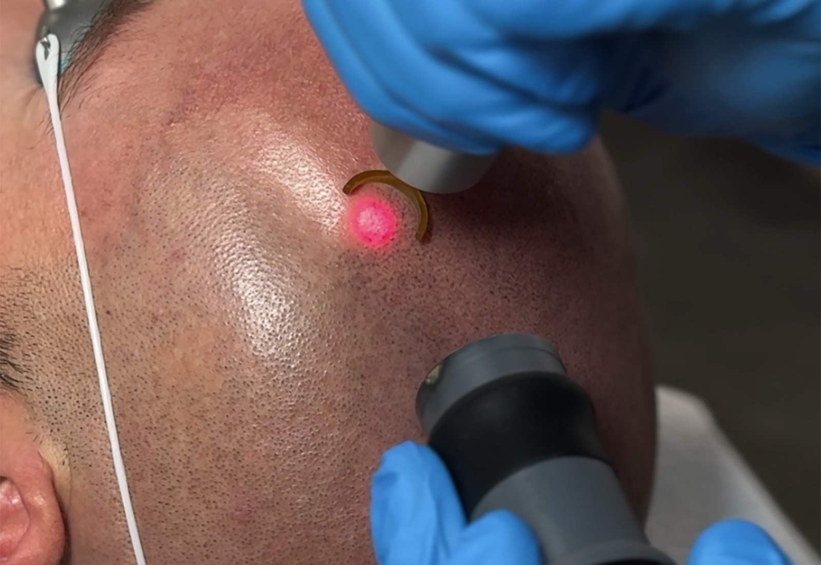 Scalp micropigmentation removal at Studio Kiku