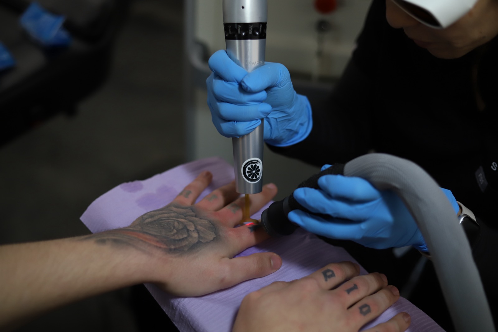 Laser tattoo removal in progress