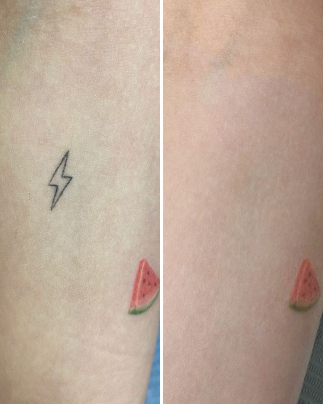 Tattoo removal — 4 sessions, complete removal