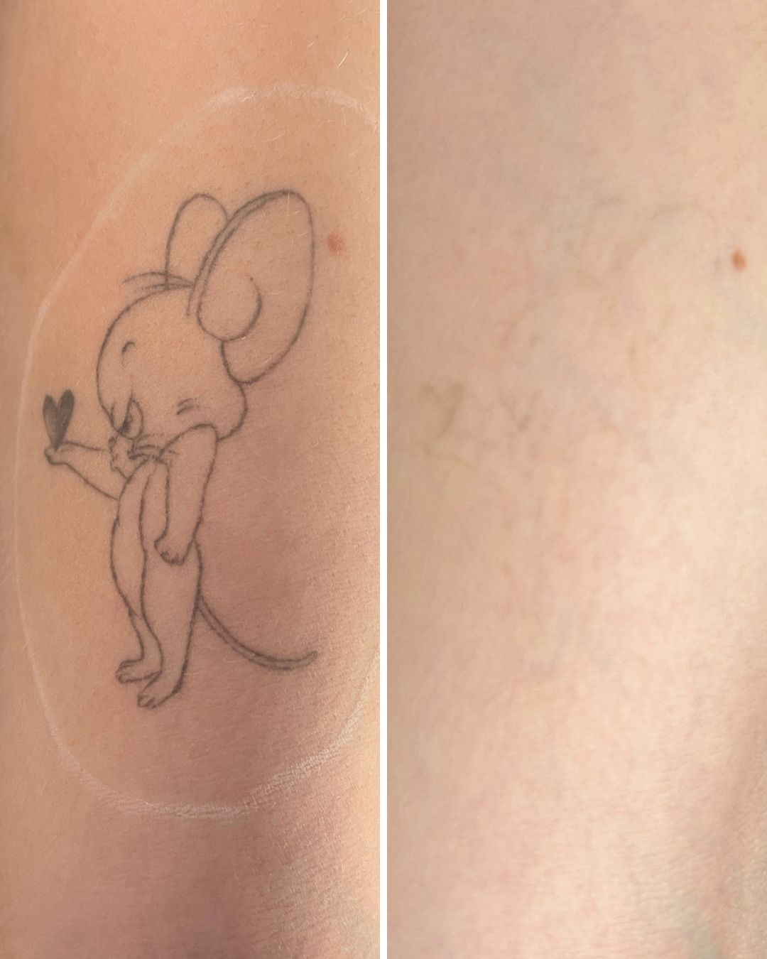 Tattoo removal result — 4 sessions
