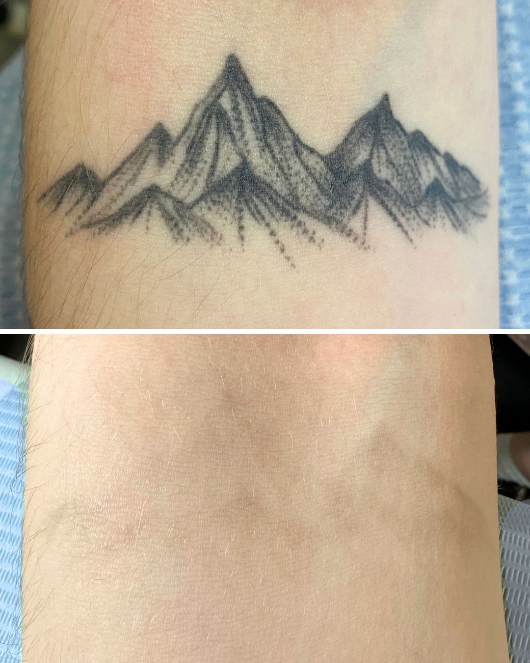 Tattoo removal result — 7 sessions